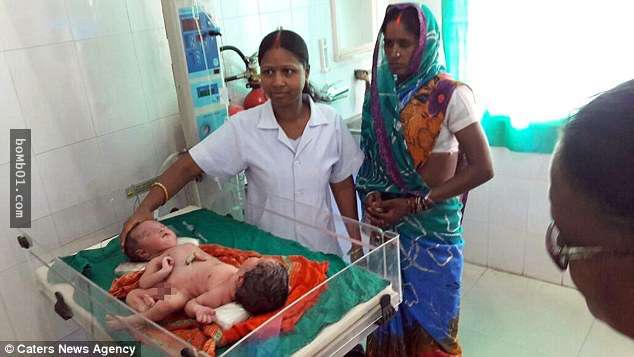印度父母終於等到雙胞胎出生後卻是悲劇的開始，一看到寶寶的情況時他們都不相信眼睛所見…