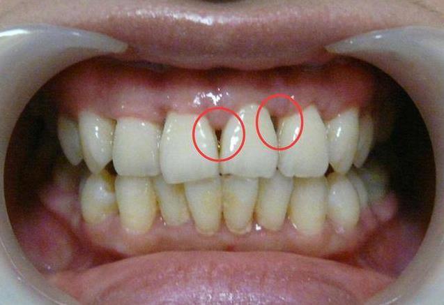[牙齦]一旦萎縮，就容易[塞牙]、[牙根酸痛]，一招可以幫到你，很簡單
