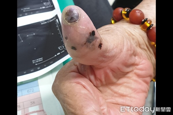 91歲阿嬤洗澡時意外摸到腋下有不明腫塊，檢查後竟是拇指30年黑痣癌變，當場嚇壞！