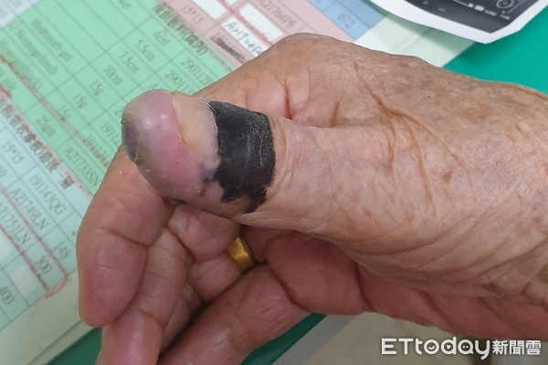91歲阿嬤洗澡時意外摸到腋下有不明腫塊，檢查後竟是拇指30年黑痣癌變，當場嚇壞！