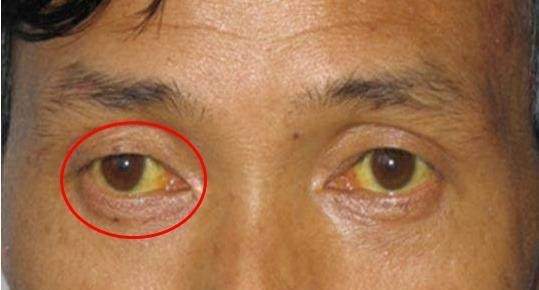 一旦眼睛出現這「8種癥狀」要當心，這可能是大病的徵兆，要及時就醫
