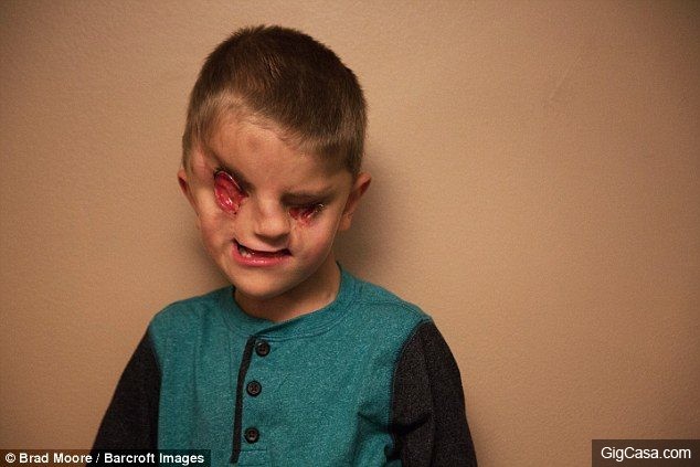 6歲男童「眼睛裂開畸形」慘遭歧視，仍樂觀生活還PO「空手道照片」他：我交到同齡朋友！(13張)