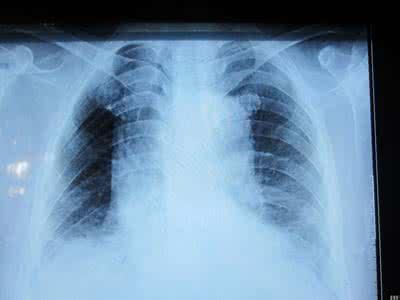 58歲女子從不抽菸，老是咳嗽出血，檢查竟得了肺癌，只因2個習慣害了她！