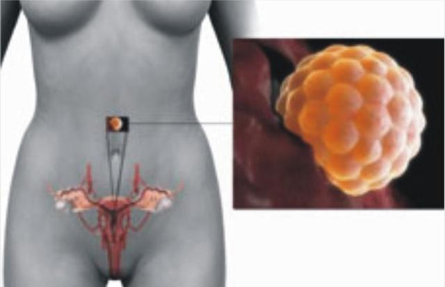 子宮癌不能吃什麼？嚴重威脅女性健康的一種惡性腫瘤!