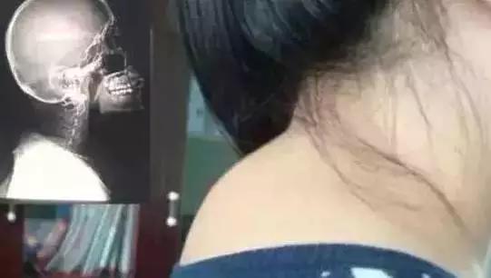 颈椎「有坨肉」,号称「富贵包」,其实是「夺命