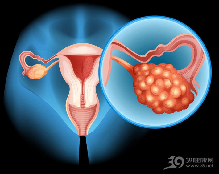 女人有這三個特徵，對不起，你已是「卵巢癌」候選人！