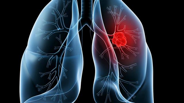 呼吸科主任提醒：下麵5個症狀是肺癌早期