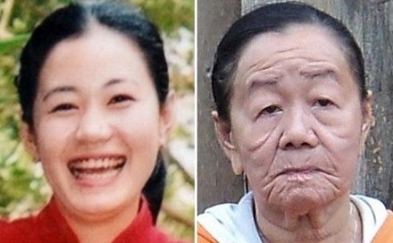 20歲少女像70歲老太，因為皮膚鬆弛症？