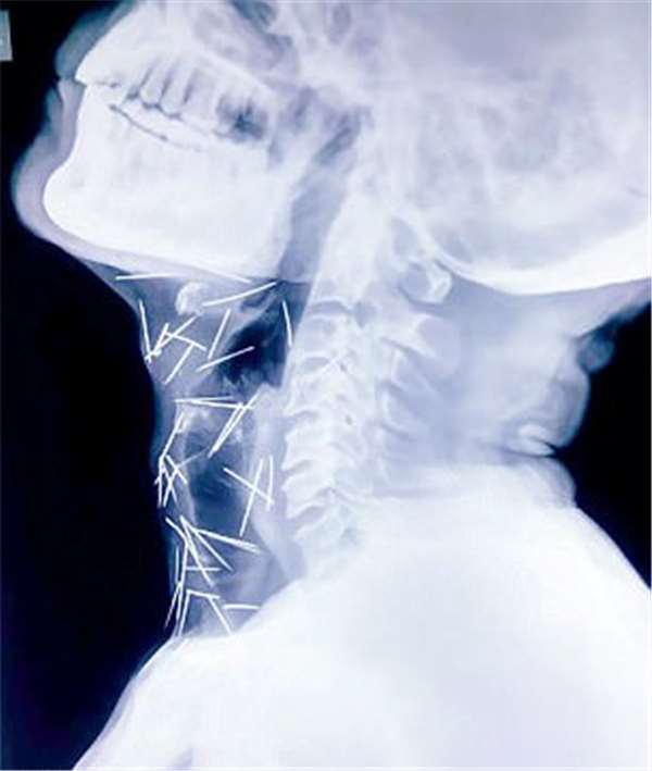 毫無緣故的腳痛讓他決定就醫，不料X光照一拍揭露這場神秘病例…尤其脖子的圖像更駭人！
