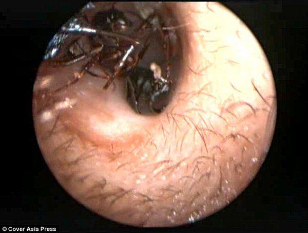 這個12歲的少女每天都會從耳朵冒出十隻「活螞蟻」！醫生掏出了1000多隻後，驚訝地發現她體內竟然是…看得我全身發癢難耐啊
