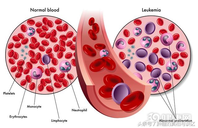 血液科主任坦言：不想白血病降臨，請避開3大誘因！