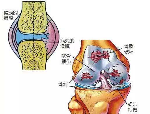 膝內有積液怎麼辦？去廚房拿一食材，15天逼走疼痛，萬人驗證！