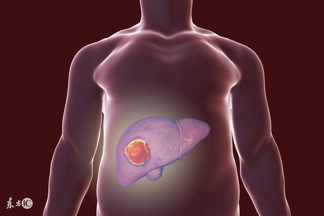 患肝癌的人越來越多？醫生提示：5類食物吃了就是「喂養」癌細胞