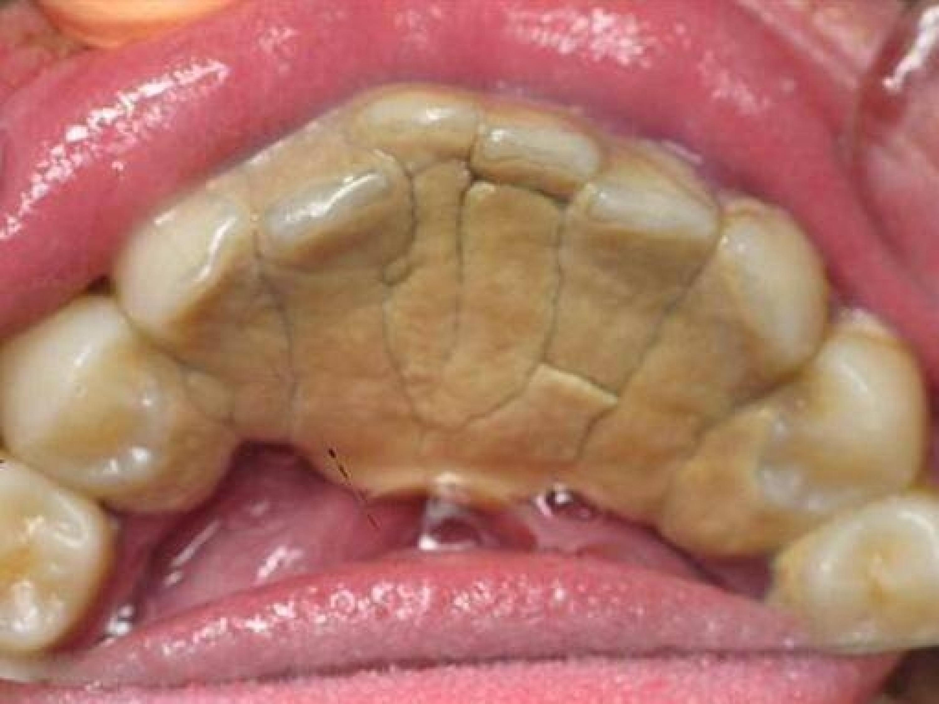 牙齿“结石”导致口腔异味怎么办？教你4招，或能有效去除它！|牙结石|结石|口腔_新浪新闻