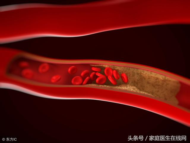 血管最怕堵塞，堅持做好這5件事，血管總是通暢無阻