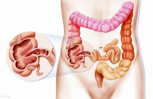 患大腸息肉的人，身上會出現5個常見症狀！