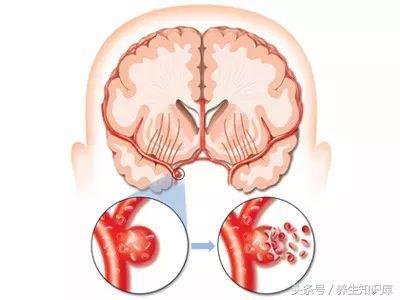 警惕：腦血管要「崩潰」的10大信號，早發現，或許能救命！