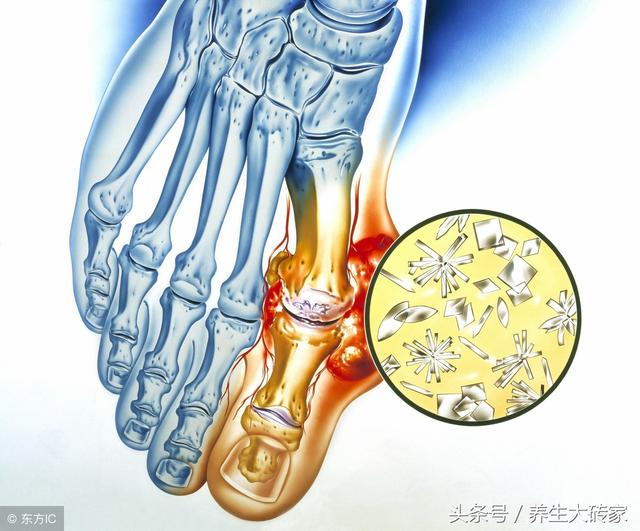 控製尿酸、防痛風「從嘴開始」，這四類食物，再喜歡也要儘量少碰