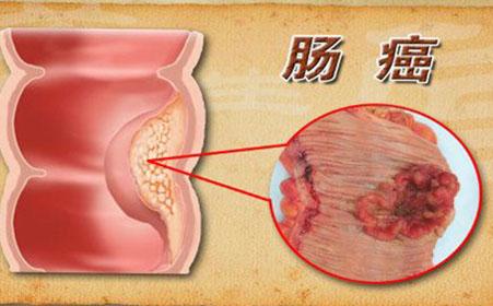 腸炎、腸癌、便秘惹人煩，請來「腸道清潔員」預防起來不算難