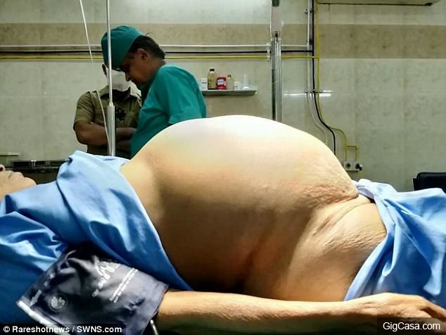 從葡萄到巨石，「還以為只是懷孕」12公斤巨大卵巢腫瘤險奪命