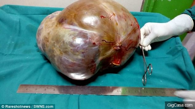 從葡萄到巨石，「還以為只是懷孕」12公斤巨大卵巢腫瘤險奪命