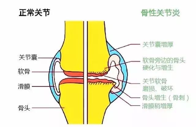 膝蓋痛千萬不能忍，一文搞定膝關節炎！