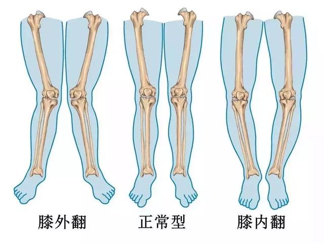 膝蓋痛千萬不能忍，一文搞定膝關節炎！