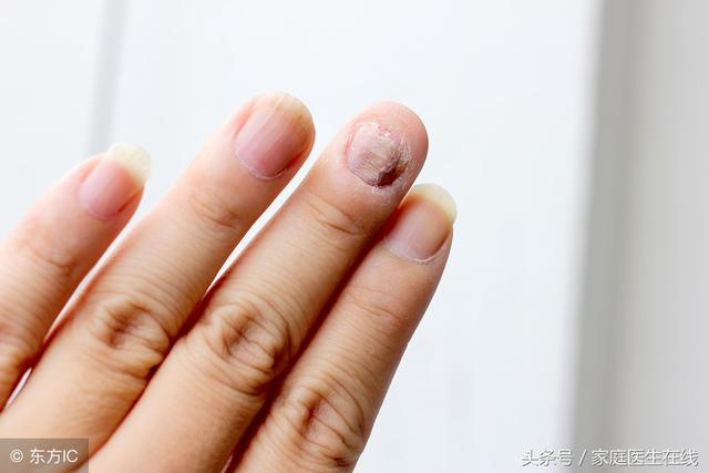 如果一直不治療灰指甲，對人有什麼影響？