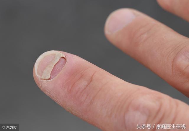 如果一直不治療灰指甲，對人有什麼影響？