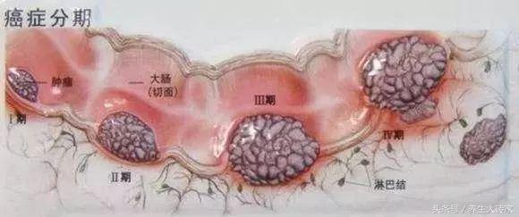 醫生提醒：有這四個症狀，可能是腸癌早期，3件事，再難也要堅持