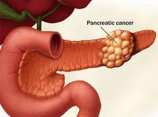 幾個壞習慣導致胰腺癌