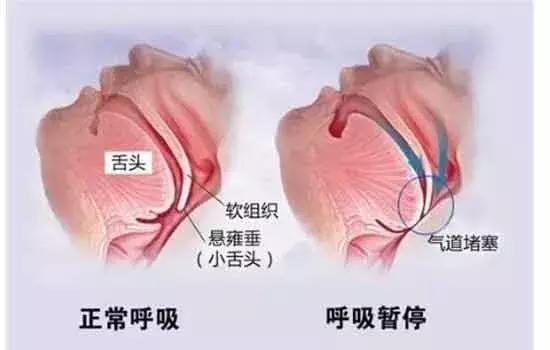 你是否被打鼾困擾著？打鼾是病嗎？我們又該如何預防？