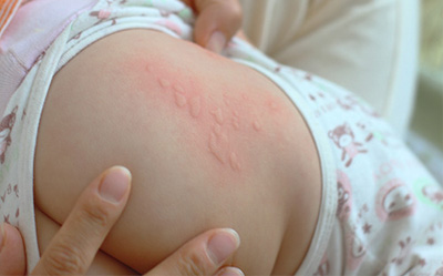 再癢也不要用手抓！專家教你用60秒就能正確治療「蕁麻疹」！