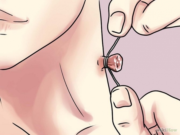 Remove a Skin Tag from Your Neck Step 10.jpg