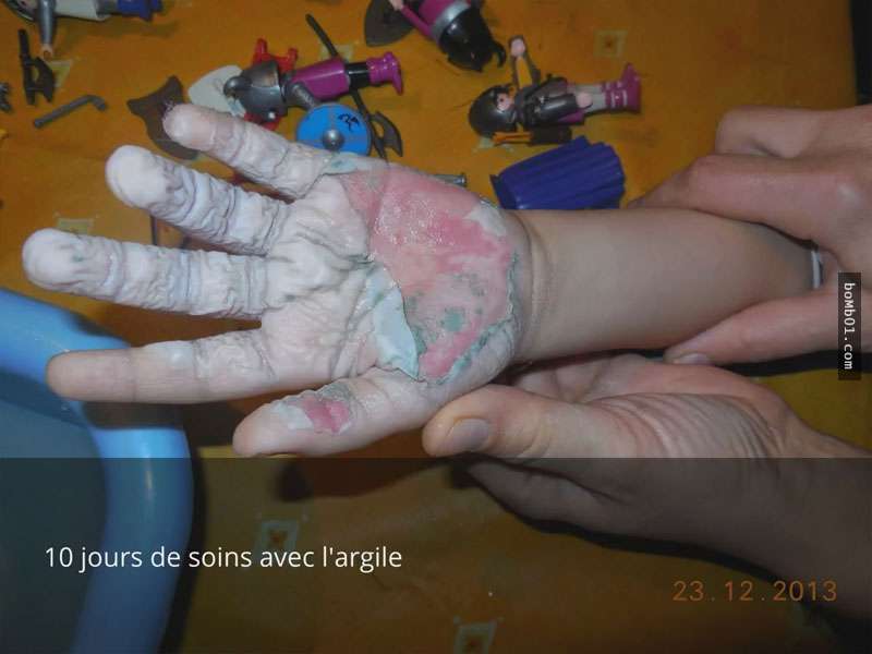 法國4歲小男孩被燙傷醫院卻拒絕開藥，結果祖傳的「神奇綠藥膏」反而救了他一命！