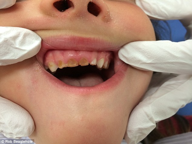 This child's teeth have been work away by drinking Coca-Cola on a regular basis
