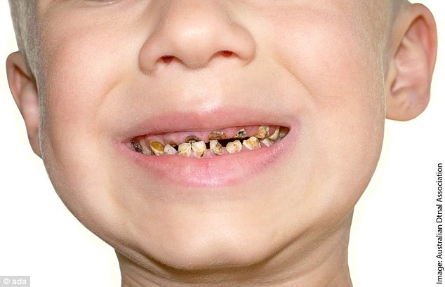 It is 'not uncommon' for children to have all of their baby teeth removed which can cause significant developmental delays down the track