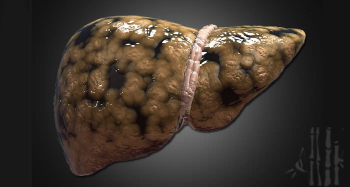 為何「肝癌」一發現就是晚期？你的肝若出現這三種症狀，就恐怖了...千萬要注意！！