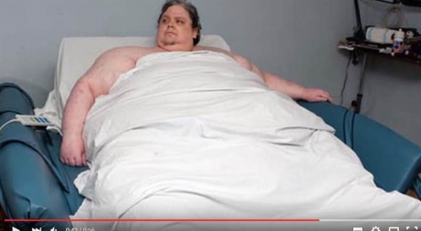445公斤肥胖男子的「X光片」讓人目瞪口呆！