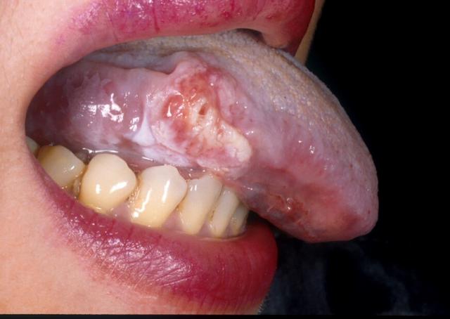舌體潰瘍反覆不癒，23歲的她確診舌癌7個月就離開了人世