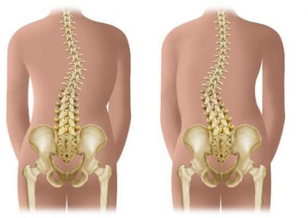 脊椎不好真的很痛苦，沒想到「免錢的脊椎矯正方法」終於找到了！超簡單，要學要快！
