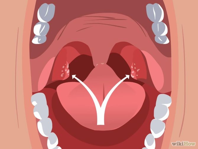 当你喉咙卡卡或是有口臭的时候,元凶可能就24%的人嘴里都有的「石子」