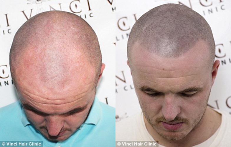 對許多男士來說，禿頭或是光頭都會造成他們缺乏自信心。<BR><BR>不過呢，經由最新「頭皮刺青」技術，不需要動手術，你就可以擁有一個平頭的「錯覺」了。<BR><BR>