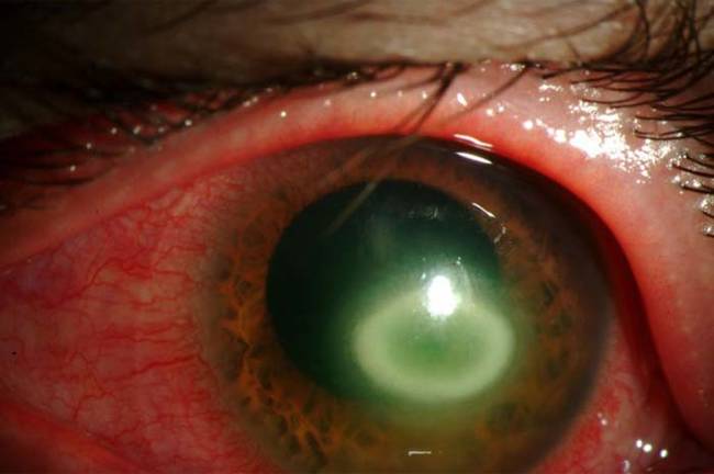 這位高姓女大生的眼睛看起來就像這樣而且她已經失明了，阿米巴原蟲引發的角膜炎可能會造成一點紅腫或疼痛，但通常不會嚴重到讓人想就醫治療。<BR><BR>