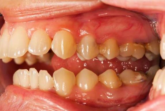 「牙結石、口臭」不用看醫生，簡單又天然的方式學起來！
