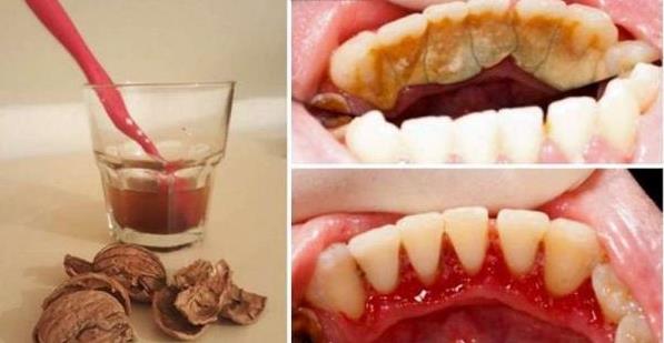 「牙結石、口臭」不用看醫生，簡單又天然的方式學起來！