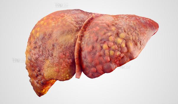 警惕肝硬化的症狀，3步可排出肝臟毒素
