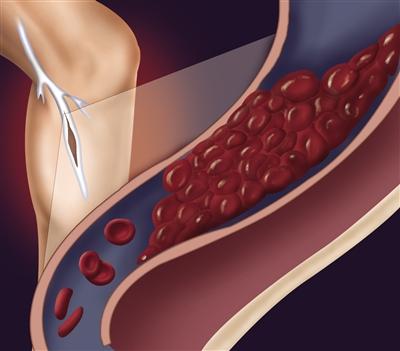 血栓是如何形成的？血栓是可防治的！補充一種食物可不被血栓困擾