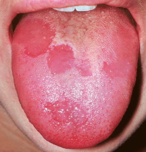 現在就伸出你的舌頭看看，如果出現這些狀況的話可要小心了！
