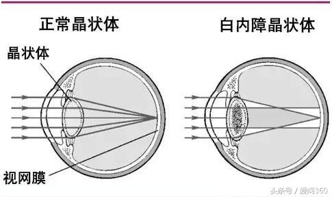 它是眼睛保護神，對近視、老花、白內障特有效